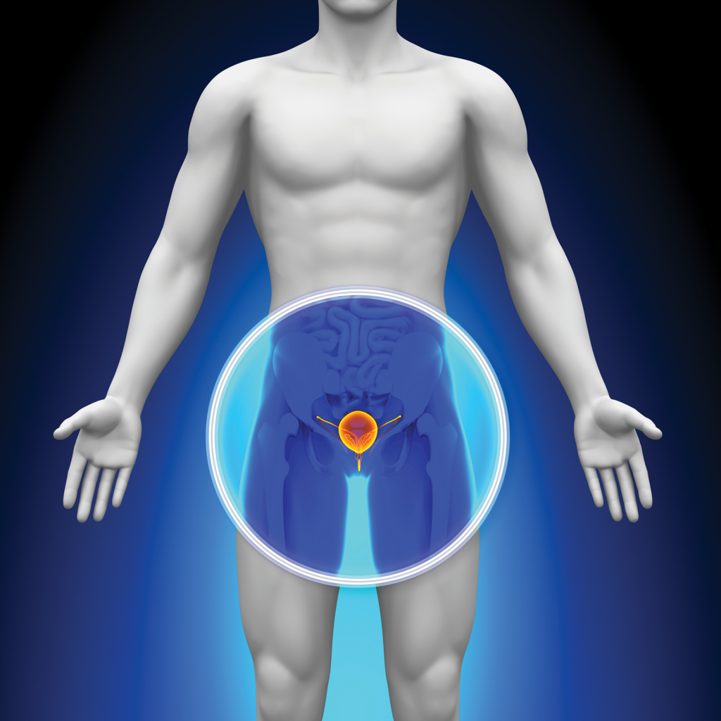 How PAE treatment for prostate works